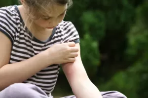 Xử trí như thế nào khi trẻ bị côn trùng cắn?